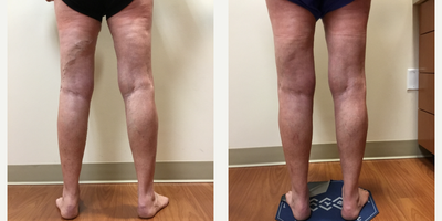 55-64 year old woman treated with EVLT, Sclerotherapy - Patient had an EVLT on greater saphenous vein, followed by Sclerotherapy treatments.