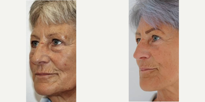 Woman treated with Carboxytherapy - Woman treated with Carboxytherapy