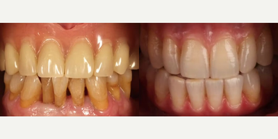 Man treated with Full Mouth Reconstruction - Man treated with Full Mouth Reconstruction