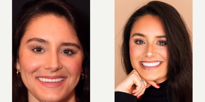 Woman treated with Teeth Whitening - Woman treated with Porcelain Veneers, Teeth Whitening