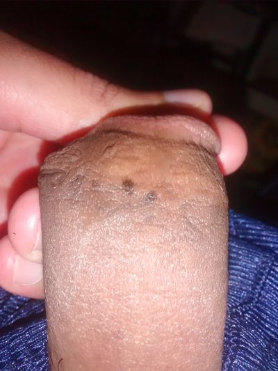 Mole On My Penis 72