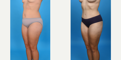 35-44 year old woman treated with Abdominal Etching, Diastasis Recti Repair, Drainless Tummy Tuck, Liposculpture, Liposuction, M - Before and after tummy tuck with lipo 360. This patient had a tummy tuck as part of her mommy makeover. She has excess skin and fat primarily below her belly button and in her suprapubic area. I did a low bikini incision removing all skin and fat from her belly button to her pubic area. I did a corset muscle plication of her stretched abdominal muscles. I did VASER ultrasound liposuction of her abdomen, flanks to shape her waist.