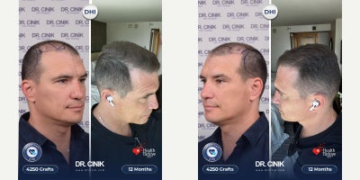 35-44 year old man treated with DHI Hair Transplant, Hair Transplant, Hair Loss Treatment - DHI hair transplant, 4250 grafts