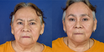 65-74 year old woman treated with Brow Lift, Eyelid Retraction Repair, Facial Fat Transfer - This female patient was concerned about her facial expression; she said she looked tired and worn out. She was concerned about her upper eyelid lateral hooding and hate her lower eyebags. I performed an endoscopic brow lift (Endobrow), upper blepharoplasty, facial fat grafting, lower blepharoplasty (transcutaneous and transconjuctival approach) and Endoscopic forehead lift and mid facelift and facial fat grafting with micro and nano fat. Now, after her periorbital rejuvenation she looks very natural refreshment expression and youthful appeareance.