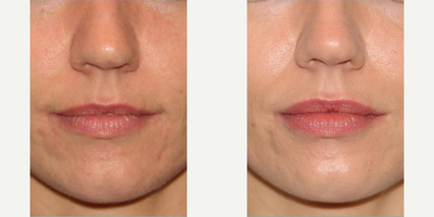 Woman treated with Restylane Refyne - This patient received Restylane Refyne to achieve beautiful natural-looking results! It is designed to help support your natural expression for results that help maintain natural movement when you're smiling, frowning and even puckering up.