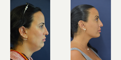 35-44 year old woman treated with Non Surgical Nose Job - Non-Surgical Rhinoplasty using Juvederm