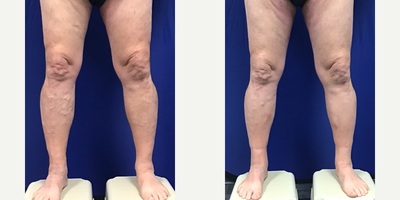 60 year old man treated with EVLT - 60 year old male vein patient treated with bi-lateral Endovenous Laser Ablations, followed by Ambulatory Phlebectomy to remove his many bulging veins.