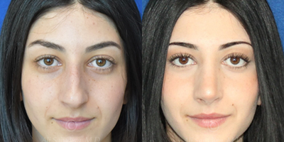 Woman treated with Rhinoplasty - Woman treated with Rhinoplasty