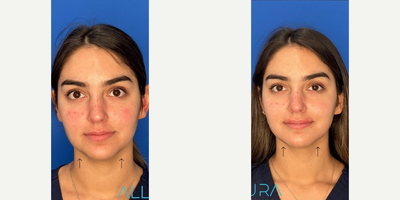 Woman treated with RHA Collection Fillers - Lower face balancing. The main concern was her prejowl area. We used RHA3 strategically on several areas in her lower face to give a natural but sculpted look