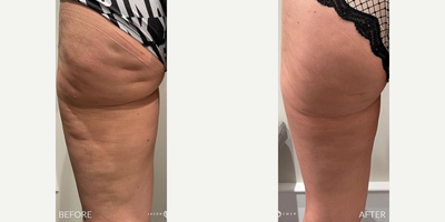 Woman treated with truSculpt iD - Woman treated with truSculpt iD