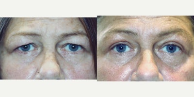 58 year old woman treated with Upper Blepharoplasty Surgery - 58 year old woman treated with Upper Blepharoplasty Surgery, giving the eyes a more youthful appearance.