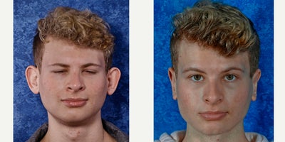 18-24 year old man treated with Earfold - This is a 19 year old young man who presented with prominent ears. He was bullied and tortured as a child. He is so upset about his ears that he cant look at himself. He has been laughed at behind his back. His self confidence was destroyed.His otoplasty was comfortably performed in the office under mild oral sedation with local anesthesia. His recovery was unremarkable. He is very happy with his result and has taken steps to treat his acne. Im thrilled that he has blossomed after surgery and has a greatly improved self-image. He is much happier.