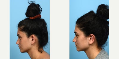 18-24 year old woman treated with Earfold, Ear Surgery - Having big ears is a common concern with a simple solution -- otoplasty, or ear surgery. Often times, overly projected ears are misconstrued as being disproportionately sized for a person's head. In truth, the issue lies in the way the ear is shaped, and by creating a new helical fold or adjusting the placement of the conchal bowl, the ears can be perceived to be much smaller. This was the case for this 24-year-old patient, who is thrilled with the outcome of her ear surgery with Dr. Wise.