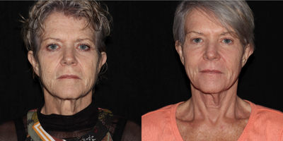 55-64 year old woman treated with SmartSkin, LED Light Therapy - This patient received SmartSkin CO2 Laser Skin Resurfacing, along with TriWave LED light therapy sessions to help speed her healing. This result is still developing as the after images are 12 days post procedure. She will be building additional collagen from this one procedure for 3 months with continued smoothing and tightening expected.