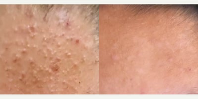 Patient treated with Skin Rejuvenation - Dont let acne ruin your day - Our patient just finished her 3rd AviClear session. The before & after results were taken between sessions 2 & 3.