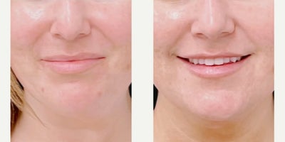 Woman treated with Skin Rejuvenation - AviClear significantly eliminates acne in three, quick 30-minute treatment sessions. And results continue to improve over time!