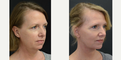 45-54 year old woman treated with Eyelid Surgery, Facelift, Lifestyle Lift, Lower Facelift, Mini Facelift, Neck Lift, SMAS Facel - This is a young woman that had a lower face and necklift procedure done, as well as an upper and lower eyelid blephorplasty. The results are refreshed and natural and she is very happy.