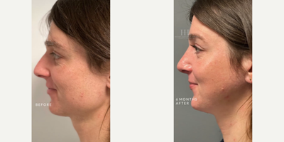 Woman treated with Adam's Apple Reduction - Woman treated with Facial Feminization Surgery through Forehead Reduction (hairline advancement), Type 3 Brow Bone Reconstruction, direct Brow Lift, Cheek Augmentation using implants, Facelift, Jaw Reduction, Adam's Apple Reduction, Rhinoplasty, and a Subnasal Lip Lift. Patient is shown before and 6 months post-op.