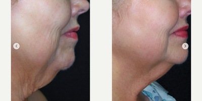 Woman treated with Skintyte - Woman treated with Skintyte