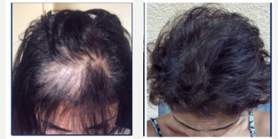 35-44 year old woman treated with Hair Transplant - This 3544-year-old female patient presented to our clinic with frontal thinning and reduced hair density that had been gradually worsening and impacting her appearance and confidence. After a thorough consultation and donor area evaluation, she was determined to be an excellent candidate for a female hair transplant using the DHI (Direct Hair Implantation) method.The procedure was carried out with the DHI technique, which allows direct implantation of grafts without creating prior incisions, ensuring high precision and natural density. A total of 2,300 grafts were harvested from the occipital donor area and carefully implanted into the frontal region, restoring volume and creating a feminine, natural-looking hairline.To improve graft survival and promote healing, one session of PRP therapy was also performed during the operation.For post-transplant care, the patient was advised to use a specialized regimen, including Folliactiv shampoo and spray containing Saw Palmetto extract, to strengthen the transplanted hair, minimize shedding, and secure long-term results.The surgery was done under local anesthesia with minimal discomfort, and the patient was able to resume normal daily life within just a few days. At follow-up, she achieved excellent density and a natural hairline design that harmonized beautifully with her facial features. The outcome provided a significant boost in both her appearance and confidence.