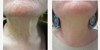 55-64 year old woman treated with Fractora RF - 55-64 year old woman treated with Fractora RF