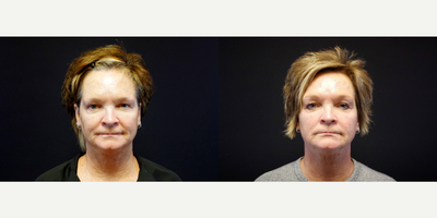 45-54 year old woman treated with Infini RF - 54 year old female received three Infini treatments to her lower face and neck; photos depict the patient's results 3 months post-treatment.