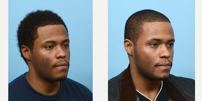 18-24 year old man treated with PicoWay - picoway for hyperpigmentation