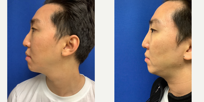 25-34 year old man treated with Nonsurgical Nose Job - Nonsurgical Nose Job