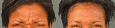 35-44 year old woman treated with Xeomin - Xeomin used for treatment of movement lines / dynamic rhytides of the glabella (11 lines) and forehead.