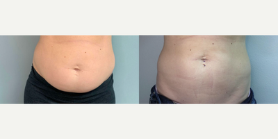Woman treated with Evolve - Evolve - 3 months post op