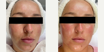Woman treated with HydraFacial - Hydrafacial