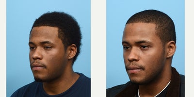 18-24 year old man treated with PicoWay - picoway for hyperpigmentation