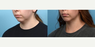 25-34 year old woman treated with Chin Surgery - This 27-year-old patient wanted to subtly enhance the projection of her weak chin, and smooth out her front jawline. Two months after her chin implant surgery, she's happy with the natural and defined appearance Dr. Wise was able to provide her.