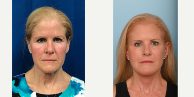 55-64 year old woman treated with Lip Lift - This patient in her 60s wanted a refreshed look. The doctor perform an Extended Deep Plane Face Lift & Neck Lift, Brow lift, Lip Lift, and Peri-oral CO2 Laser to tighten her neck and jowls and the lip lift shortened the space between the nose and top of the lip.