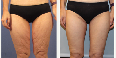45-54 year old woman treated with Thigh Lift - 1 month after a thigh lift. The scars will fade with time. She has a vertical scar and a horizontal scar at the top.