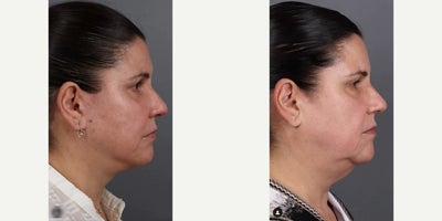 Woman treated with Deep Plane Facelift, Neck Lift, Eyelid Surgery, Facial Fat Transfer - Woman treated with Deep Plane Facelift, Neck Lift, Eyelid Surgery, Facial Fat Transfer