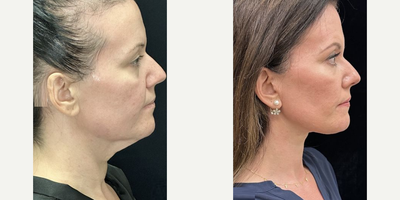 44 year old woman treated with Deep Plane Facelift, Neck Lift, Facial Fat Transfer - 44 year old woman treated with Deep Plane Facelift, Neck Lift, Facial Fat Transfer