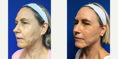 65-74 year old woman treated with Sculptra Aesthetic - This very pretty woman had a compliment of facelift and Sculptra injections.