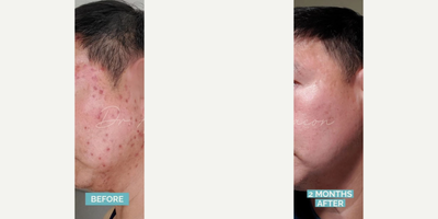 Man treated with Accutane - My patient came to us with excoriated acne, featuring papules and pustules on the bilateral cheeks, along with ice pick and depressed scars from excoriation.
