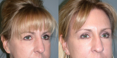 45-54 year old woman treated with Brow Lift - This 50 year old woman wanted to rejuvenate her forehead and upper eyelids. She had an endoscopic brow lift with small incisions hidden in the hair, as well as an upper eyelid lift using a CO2 laser. Her results are shown 6 months later.