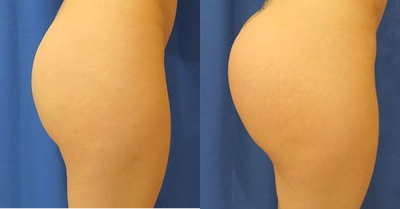 Woman treated with Butt Implants - Woman treated with Butt Implants