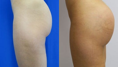 Woman treated with Butt Implants - Woman treated with Butt Implants
