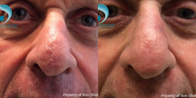 65-74 year old man treated with Fraxel repair for Scar Removal - This gentleman underwent two Fraxel Repair laser treatments for a scar after reconstruction for his Mohs surgery removal of a skin cancer. Thick oily skin of the nose not uncommonly forms grooves or widened pores in surgical scar as people heal in the first few months after surgery. Fraxel Restore can be done as a series of several treatments but he chose to have a couple of Fraxel Repair laser treatments that are more efficient but involve a week of mild wound care. He was extremely happy with the outcome. All treatments done by Dr. Shelton