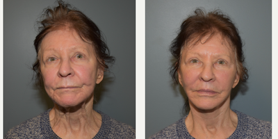 75 and up year old woman treated with ActiveFX - This woman is 76 years old, 5'2 and 125 pounds. She presented requesting lower face and neck lift. She also had a sub-nasal lip lift and CO2 laser resurfacing of her central face.