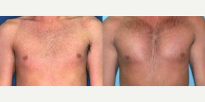 Man treated with Pec Implants - Man treated with Pec Implants