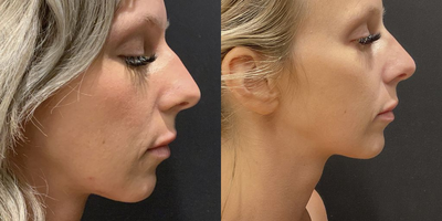 Woman treated with Rhinoplasty - Woman treated with Rhinoplasty