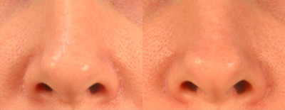 35-44 year old woman treated with Venus Viva - Venus Viva fractional radiofrequency/RF treatment is fantastic for facial resurfacing (wrinkles, sun spots, crepe skin, fine lines, pore reduction, and texture improvements), scars, and melasma. Since it is not a laser it can be used on all skin types (including darker skin and sensitive skin like those with eczema and/or rosacea). It is also fantastic for acne, as it helps the topical medications used to treat acne to penetrate the skin more readily. Long term tightening and lifting is improved with Venus Viva in combination with other skin tightening procedures such as radiofrequency/RF like Venus Legacy or ultrasound like Ultherapy.