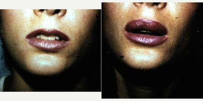 18-24 year old woman treated with Lip Surgery - A triple V to Y mucosal advancement was performed on the upper lip. This rotated the internal mucous membrane outward to produce a fuller lip.