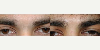 25-34 year old man treated with Laser Hair Removal - Whether it's a unibrow or another annoying location, unwanted hair is easy to permanently remove with lasers.  All skin types are candidates too!