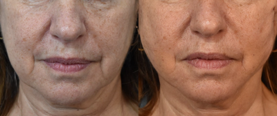 55-64 year old woman treated with Silhouette InstaLift - Over 50% of my patients complain about their Jawline. Instalift provides an immediate jaw lift with very little downtime, and lasts 2 years!